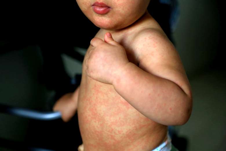 Parents are being urged to get their children vaccinated against measles if they have not already been, PHOTO: Adobe Stock
